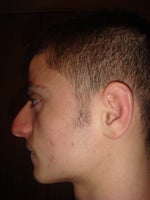 Getting a nose job at 18 a good idea?
