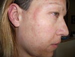 Burn from 25% TCA peel followed by 25% Jessnors for melasma