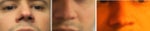 Injectiable filler to improve appearance of nose tip?