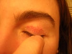 Upper blepharoplasty suture reaction?