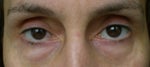 What do I need to do: remove bags under eyes or fillers?