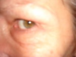 Heavy eyebrows, chipmunk cheeks after Botox