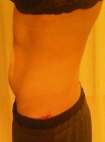 Am I a good candidate for Smart Lipo?