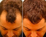 Hair Transplant before and after photos