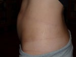 Accent XL or Thermage for non-surgical treatment of stretch marks?