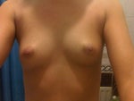 Are high profile implants suitable for me?