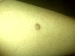Cost to remove dark cyst/lump on leg