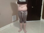 Can a 16 year old have Smart Lipo performed?