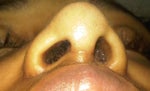 Uneven nostrils 1.5 months after rhinoplasty