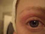 Upper Blepharoplasty scar not in crease