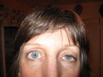 Developed droopy eyelid after botox treatment 
