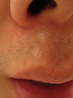 Treatment for Chicken Pox scars (white and depressed)