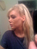 Nose tip upturned after rhinoplasty