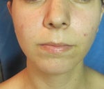 Why does my nose look the same 5 1/2 weeks after rhinoplasty?