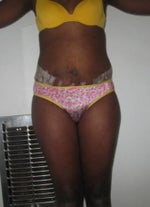 RE: Drainage and swelling after Smart Lipo and Tummy Tuck