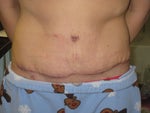 Pain when without compression garment after tummy tuck