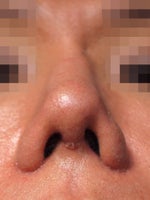 Fixing asymetrical nostril after revision rhinoplasty with ear graft?