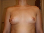 Can breast implants make breasts look symmetrical?