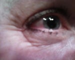 Improving undereye wrinkles