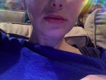 My doctor says she can't inject Radiesse into jaw line