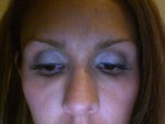 Can PMMA lumps under the eyes be removed by blepharoplasty?