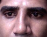 Remove nasal implant or wait and see?