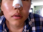 Uneven nostrils and pig-like appearance due to rhinoplasty swelling?