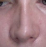 Uneven swelling after cast removal?