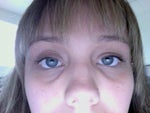 How effective is fat grafting to eliminate dark circles under eyes?