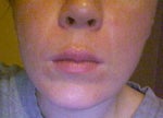 Shortening nose to lip distance