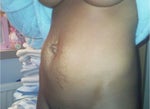 Would I have a high scar after a tummy tuck?
