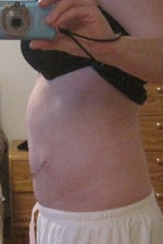 Upper abdomen bulge after tummy tuck