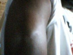 Can lipoma come back?
