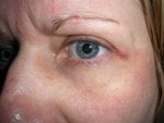 Hard lump at corner of eye after upper blepharoplasty