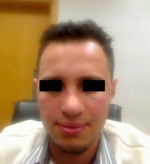 Rhinoplasty swelling after 16 days