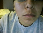 How to get rid of upper lip hyperpigmentation?