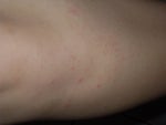 Treatment for Small Red Spots on Legs?