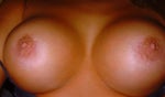 Remove implants or have them replaced with smaller ones?