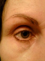 Blue veins under eyes