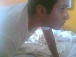 Tip appearance 2 months after rhinoplasty