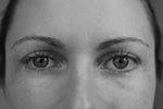 How to correct post-blepharoplasty asymmetrical lower eyelids? 
