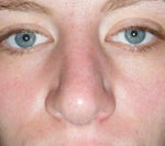 Asymmetrical or Crooked Nose After Rhinoplasty?