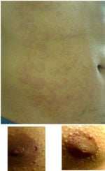 Laser Hair Removal Burn on Chest and Abdomen