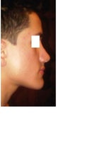 Elevation in supratip after rhinoplasty