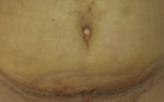 Belly button looks big after tummy tuck