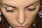 Another revision to straighten crooked nose?