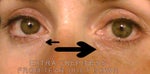 Under eyes crepey after using Retin-A