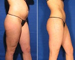 Zerona before and after photos