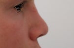 Nose after 6 rhinoplasties