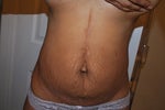 With previous large vertical scar, what type of tummy tuck do I need?